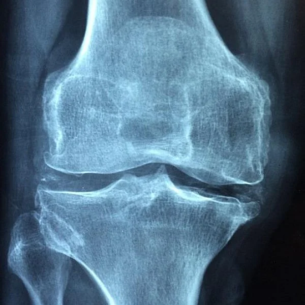 Pain in bone... Don’t ignore Osteoblastoma could be the reason!