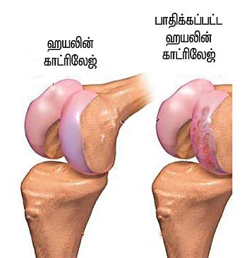 மூட்டு வலி... தப்பிக்க வழி