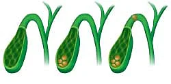 பித்தப்பை கல்