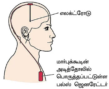 பார்க்கின்சன் நோயை வெல்ல...