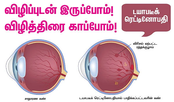 விழிப்புடன் இருப்போம்! விழித்திரை காப்போம்!