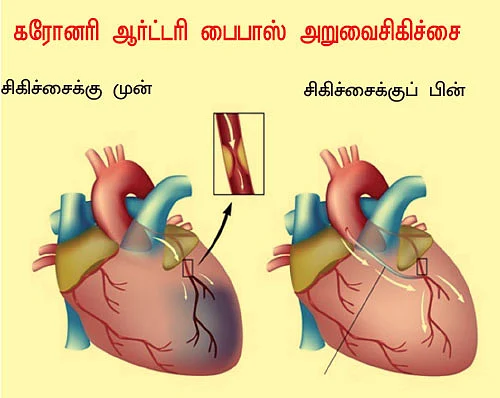 இதயம் காக்கும் சிகிச்சைகள்!