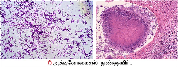 மட்க வைப்பதில் மன்னன் ஆக்டினோமைசஸ்! - உதவிக்கு வரும் உயிரியல் - 12