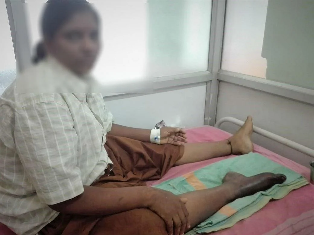 கர்ப்பப்பை கட்டி ஆப்ரேஷனுக்கு சென்ற பெண் காலை இழந்த பரிதாபம் - விருதுநகர் அரசு மருத்துவர்களின் அலட்சியம்..!