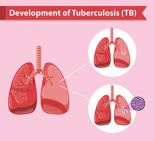 Tuberculosis