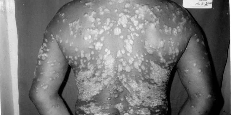 Psoriasis
