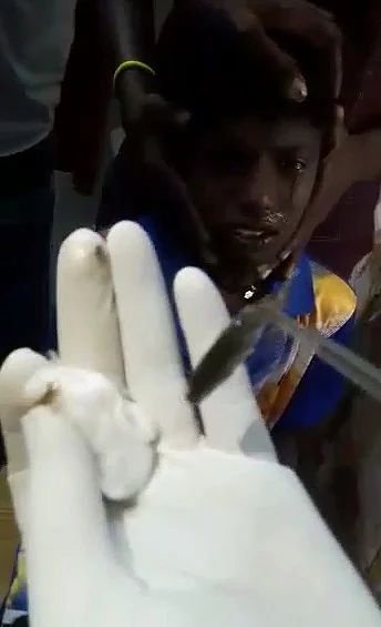 சிறுவனின் மூக்குக்குள் சென்ற சிலேபி மீன்! - லாவகமாக அகற்றிய புதுக்கோட்டை அரசு மருத்துவர்