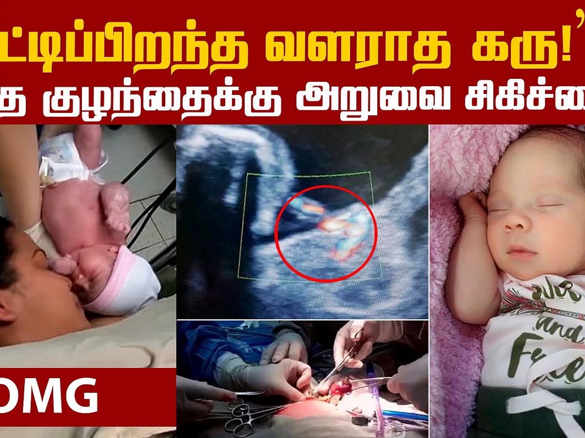 Fetus in the fetus - Pregnant woman faces rare C section surgery!