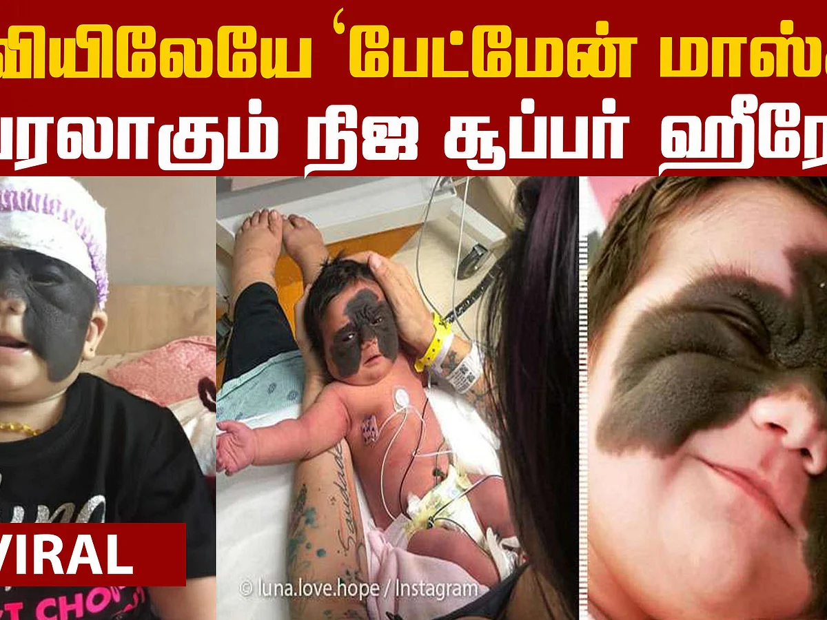 Baby Was Born With A 'Batman Mask' Birthmark