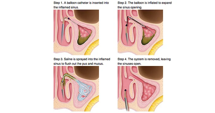 விடாமல் துரத்தும் சைனஸ் பிரச்னைக்கான தீர்வு! #Balloon_Sinuplasty