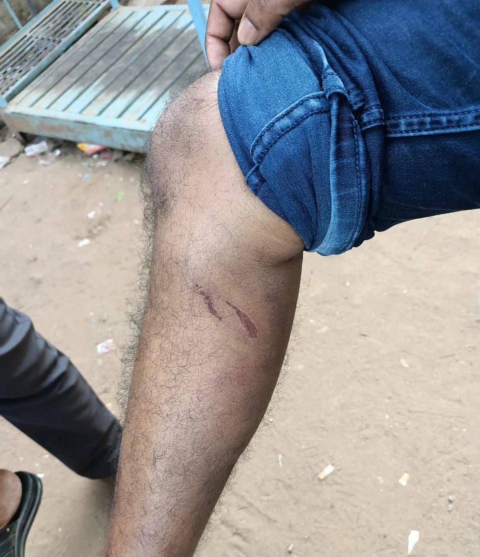 காலில் காயத்தைக் காட்டும் பிராங்ளின்