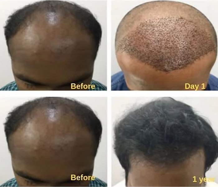 ஊசிபோட்டால் தலைமுடி வளருமா...? #HairGrowthwithoutSurgery
