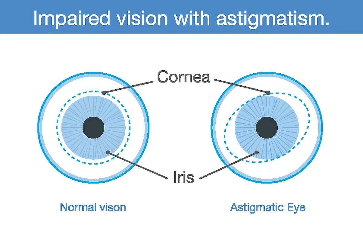 Astigmation
