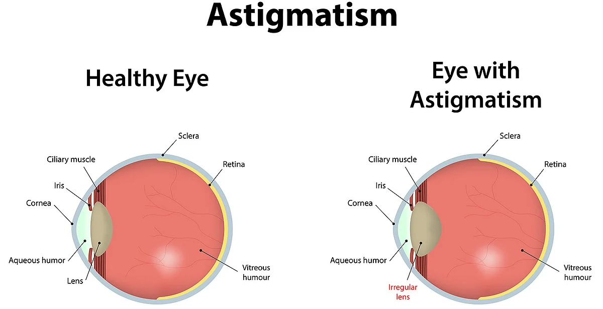 Astigmation