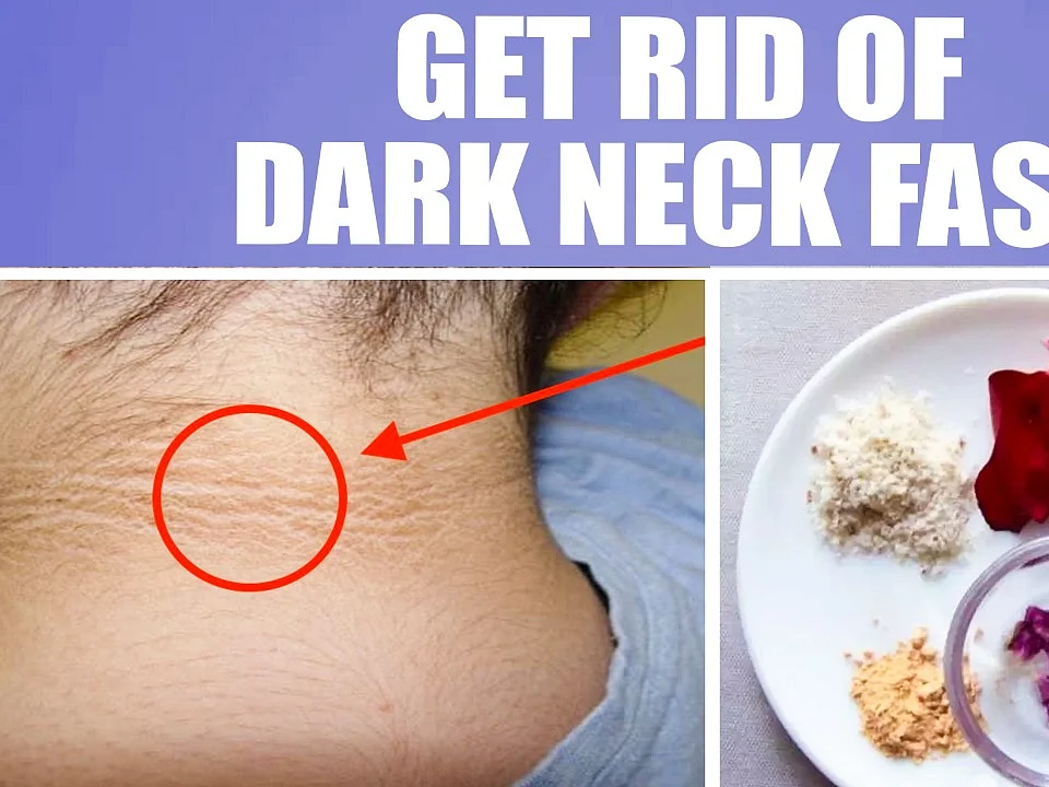 கழுத்தில் உள்ள கருமையை நீக்க 3 எளிய வழிகள்! Dark neck removal | #15dayschallenge Day 11