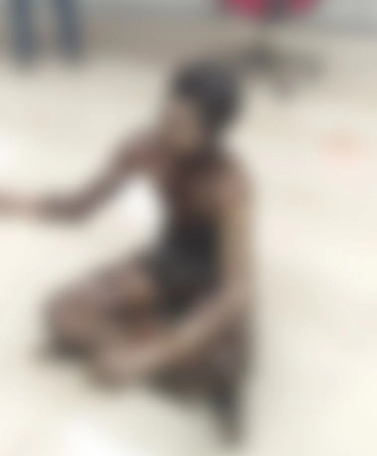 தீக்காயமடைந்த தொழிலாளர்களில் ஒருவர்