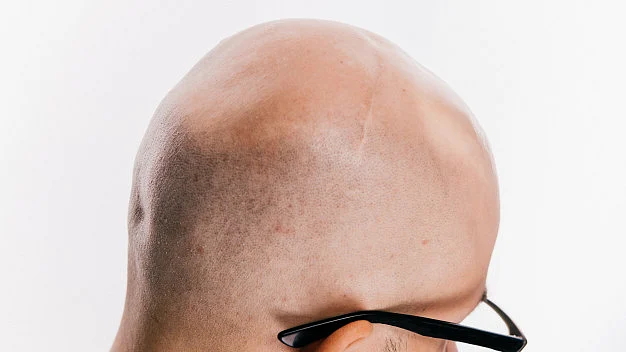 bald head