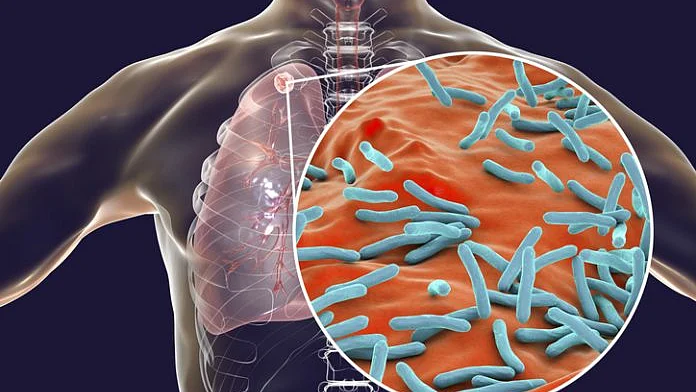 Tuberculosis