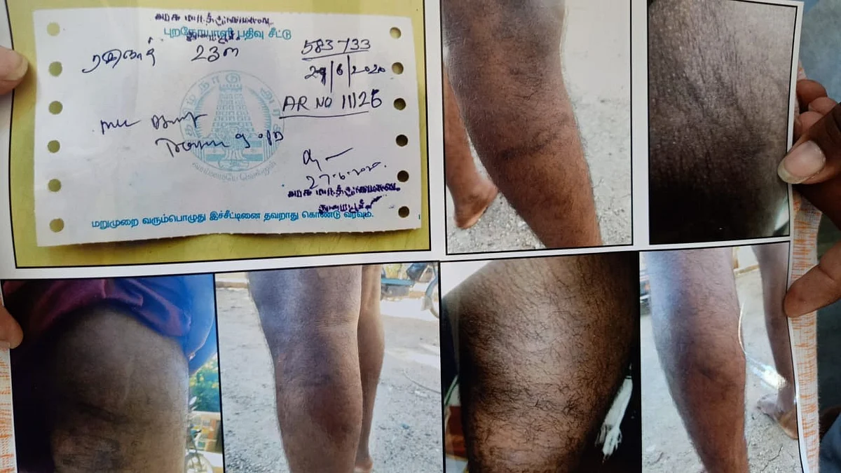 போலீஸார் அடித்ததில் காயம்