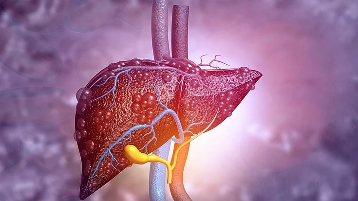 Liver Cirrhosis