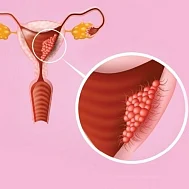 pcos