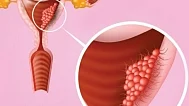 pcos