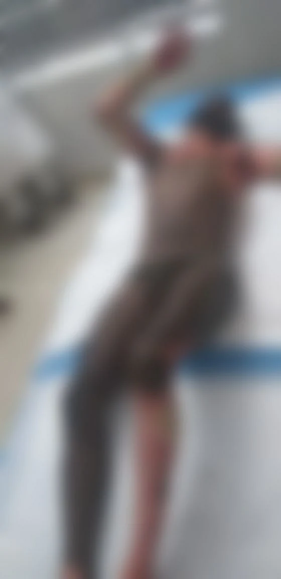 பெட்ரோல் ஊற்றி எரித்ததில் தீ காயம் அடைந்தவர்