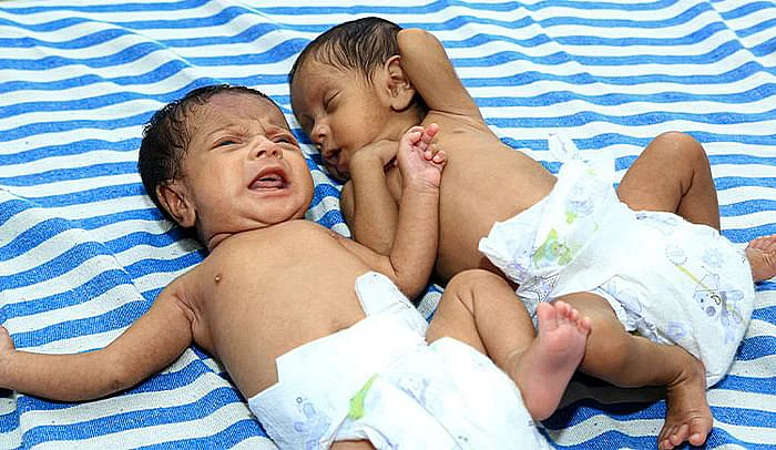 'ரெட்டக் குழந்தையில ஒன்னு சாகக்கெடக்குது! காப்பாத்துங்க' #SaveTwins