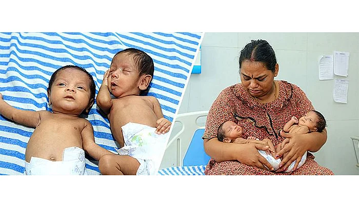'ரெட்டக் குழந்தையில ஒன்னு சாகக்கெடக்குது! காப்பாத்துங்க' #SaveTwins
