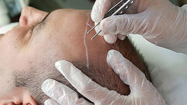 ஹேர் டிரான்ஸ்பிளான்டேஷன்