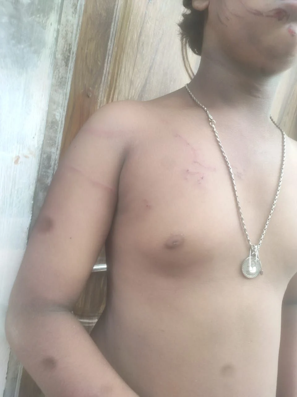 சிறுவனின் உடம்பில் ஏற்பட்ட காயங்கள்