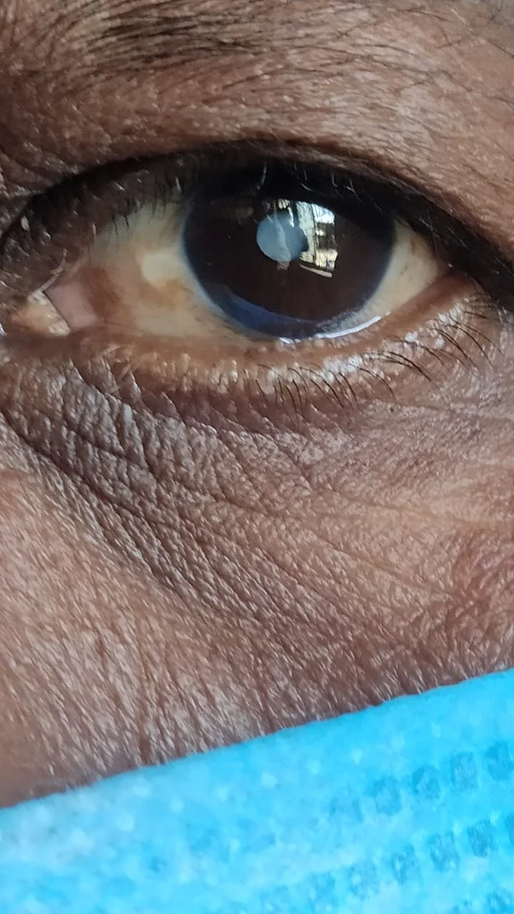 கண்புரை