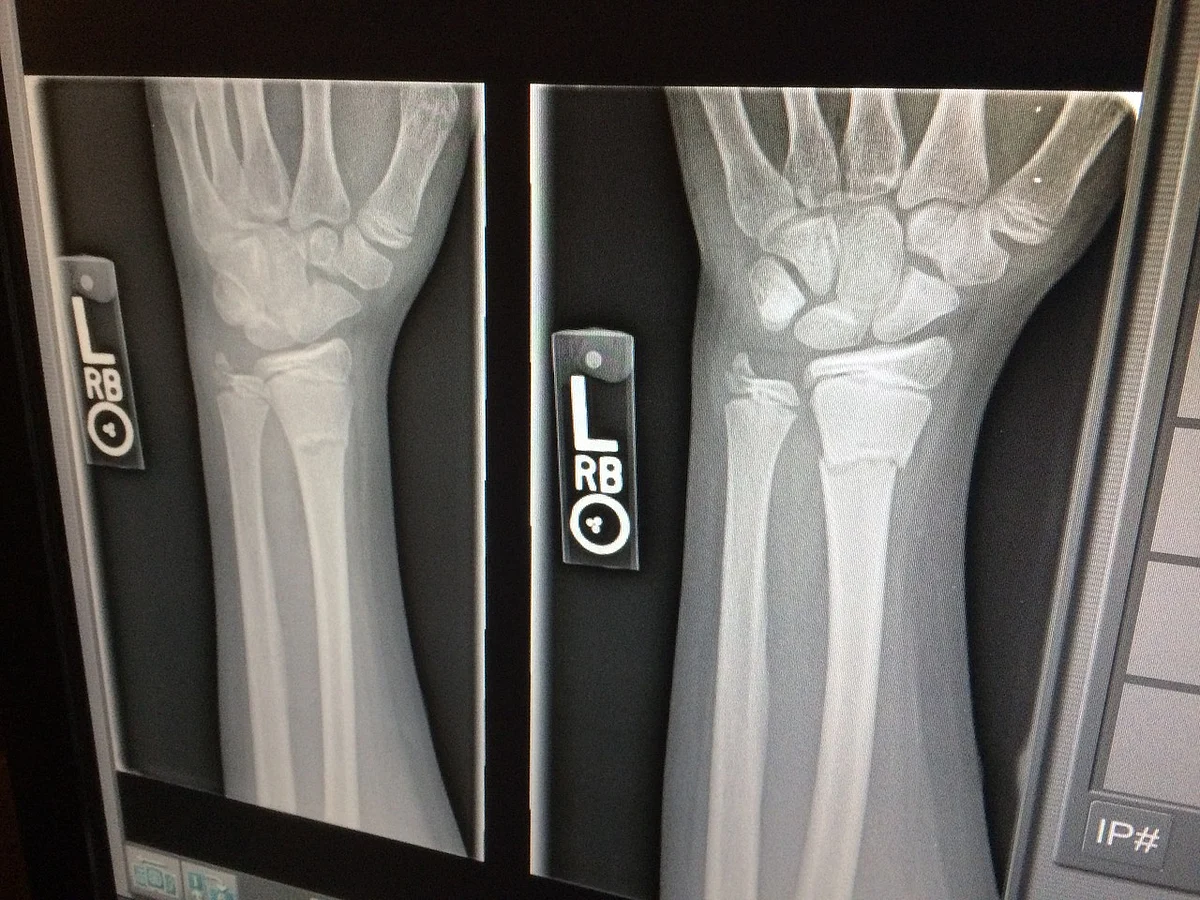 X Ray (Representational Image)