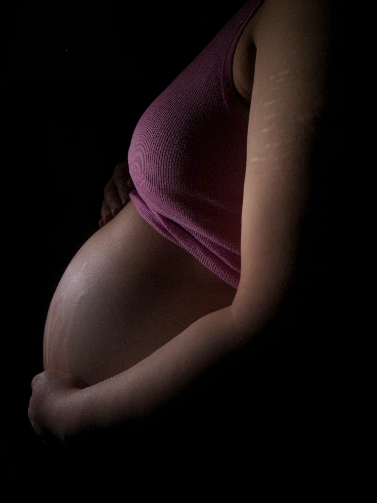 Stretch marks(Representational Image)