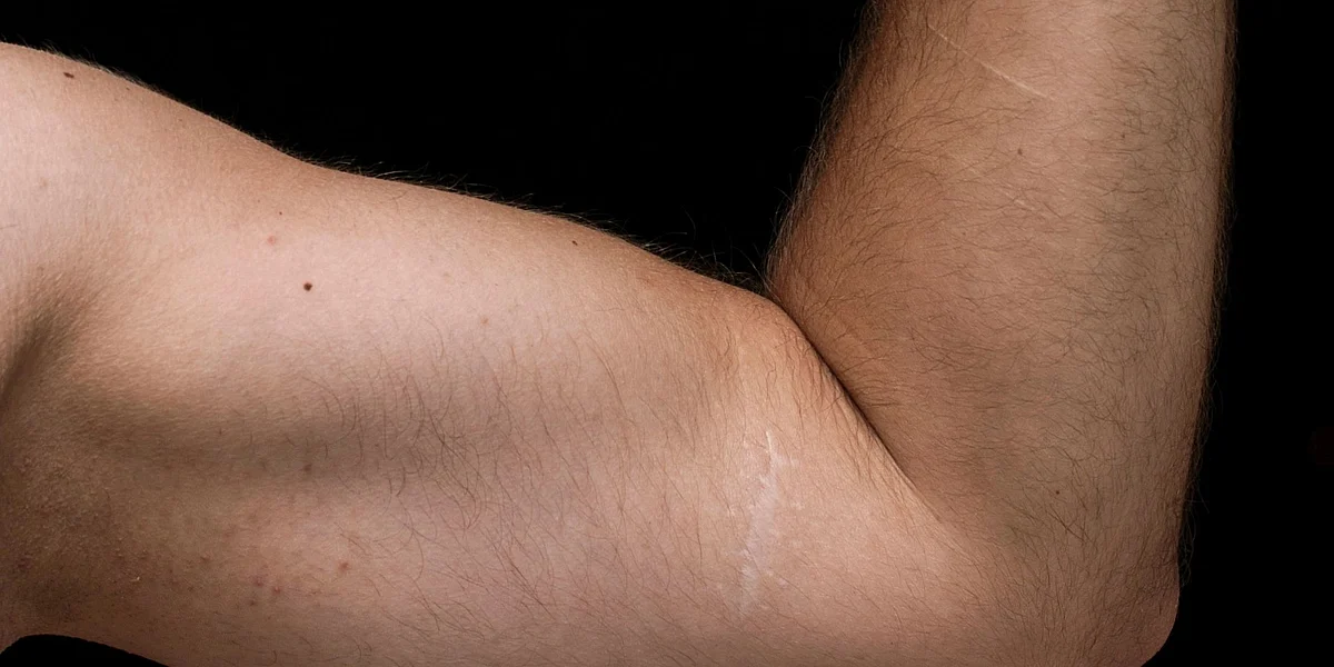 Stretch marks (Representational Image)