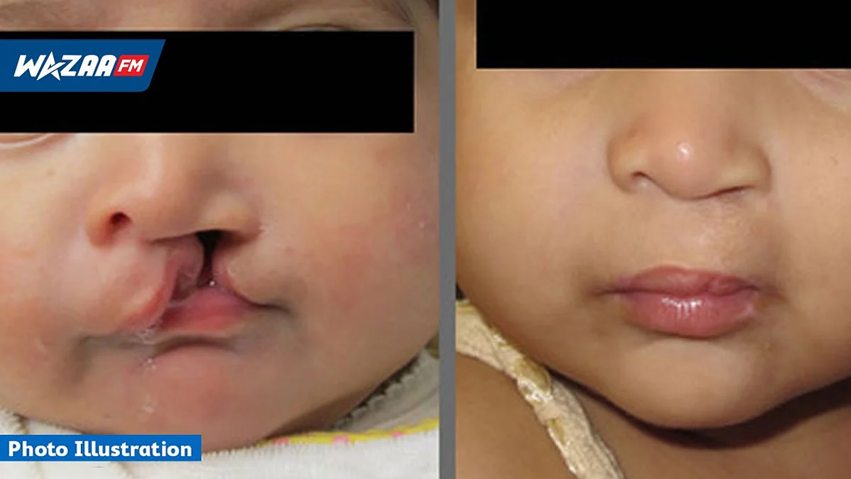 Malformations faciales : une quinzaine de cas recensés chaque année