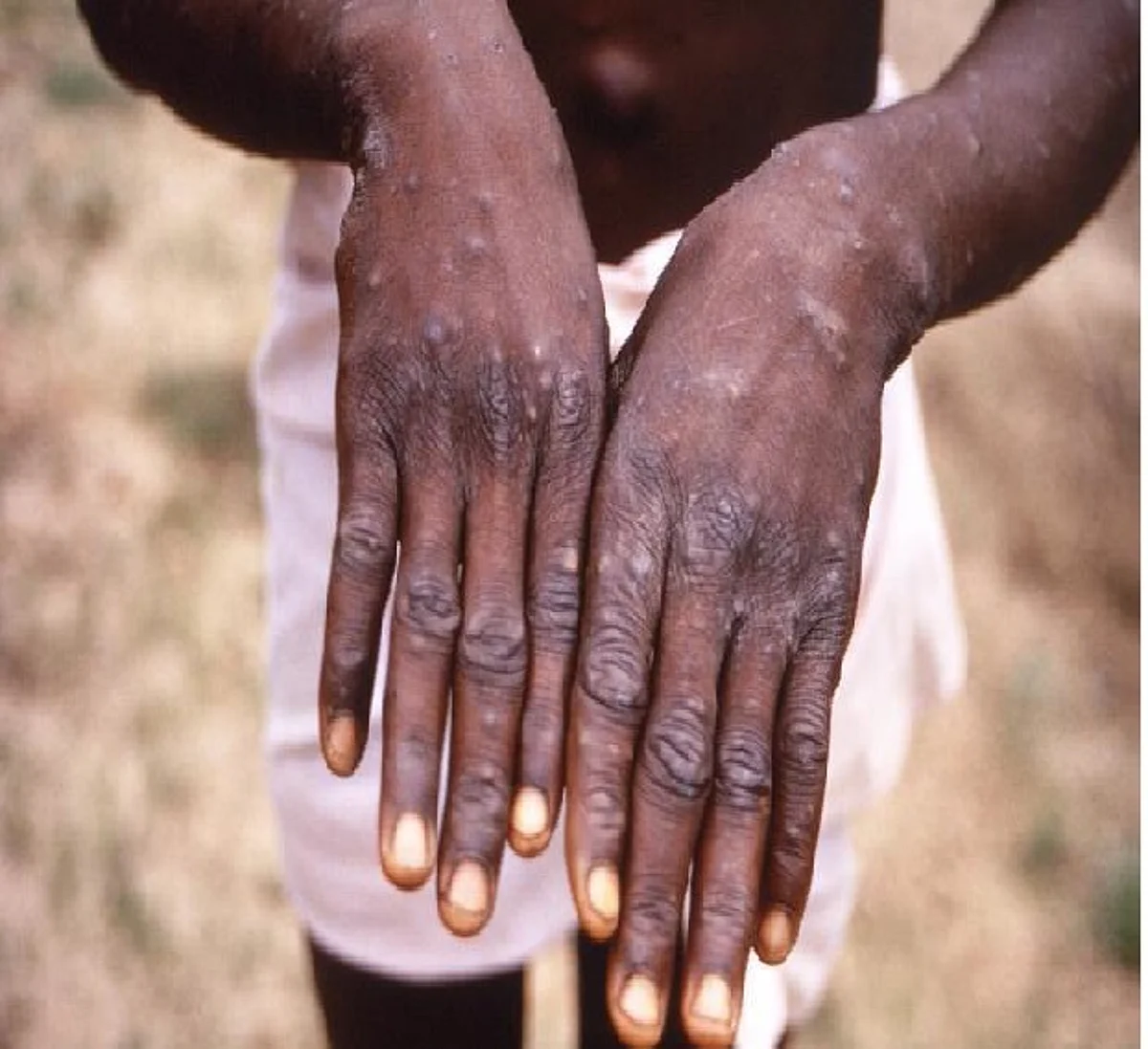 How humans can contract monkeypox- NCDC