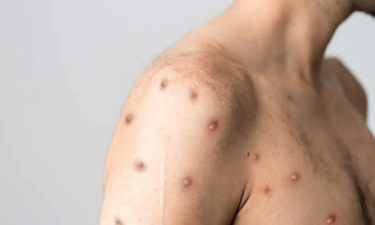 Monkeypox Case in Delhi: दिल्ली में मिला मंकीपॉक्स का पहला मरीज, देश में वायरस का चौथा मामला