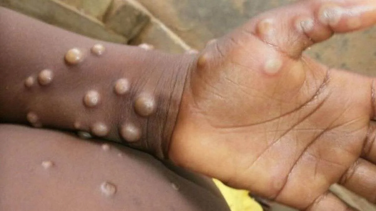 Monkeypox in Ghaziabad: गाजियाबाद में मिला मंकीपॉक्स का संदिग्ध मरीज, जांच के लिए पुणे भेजा गया सैंपल