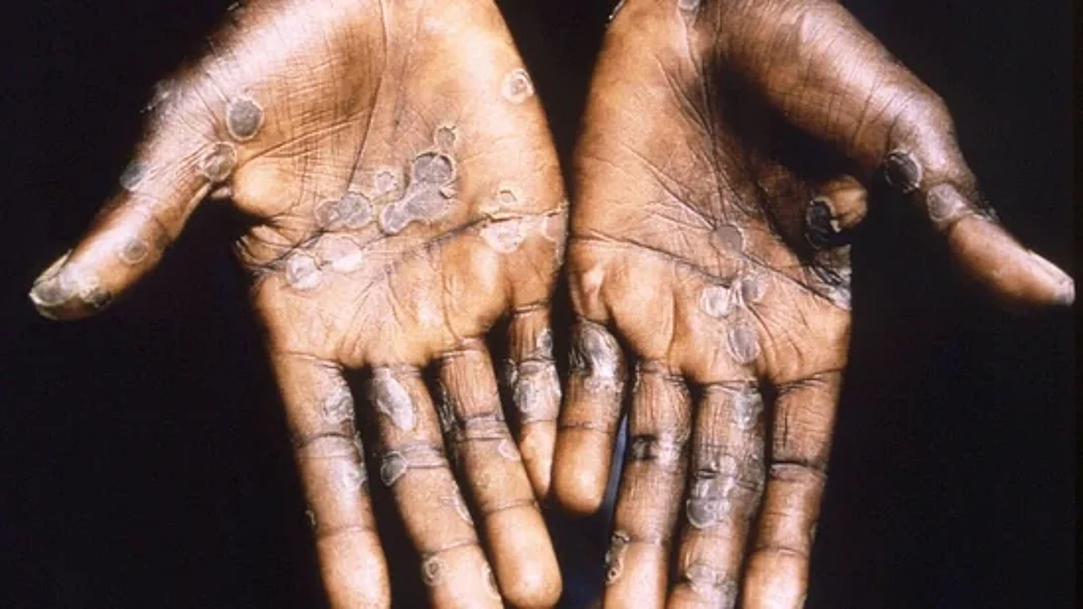 Monkeypox के खतरे को लेकर केंद्र सरकार ने राज्यों को चिट्ठी लिख किया आगाह, रोकथाम के लिए दिए ये निर्देश