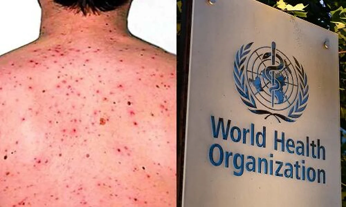 Monkeypox Cases: WHO ने कहा, मंकीपॉक्स के प्रकोप को नियंत्रित किया जा सकता है