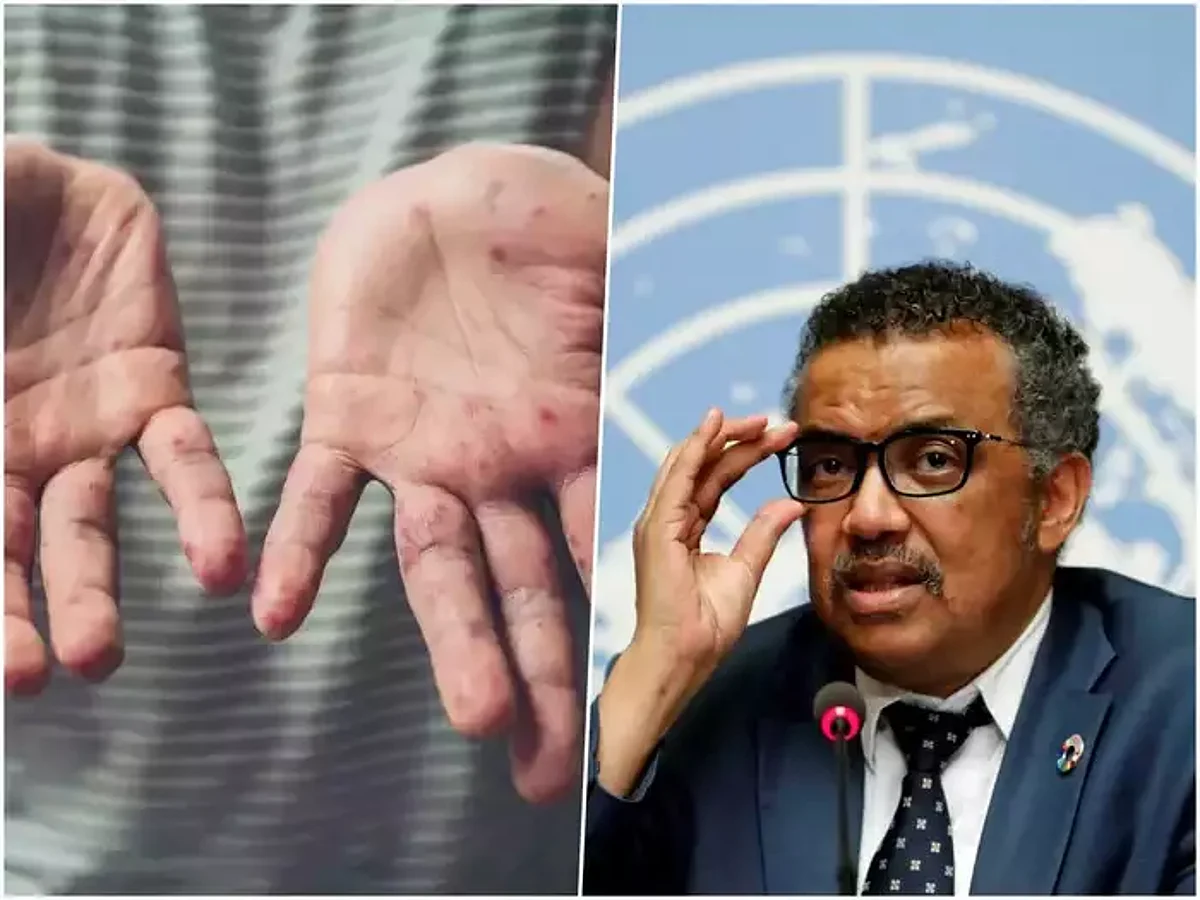 Monkeypox : WHO की चेतावनी, मंकीपॉक्स से और अधिक मौतें हो सकती हैं